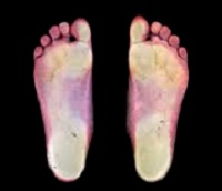 Borcení klenby příznaky